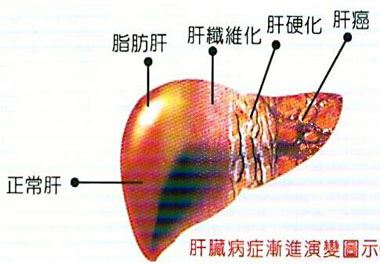 脂肪肝演變過(guò)程