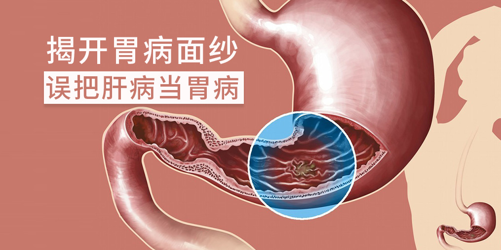 警惕“假胃病”,小心是肝有問題